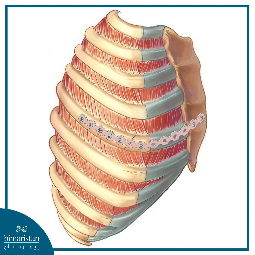 Broken Ribs Treatment In Turkey: Methods, Recovery &Amp; Care 4 Plates And Screws Used In Surgery For Broken Ribs Treatment