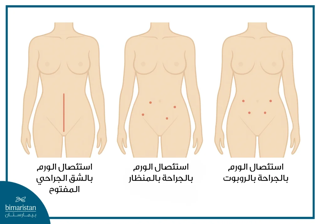 استئصال الورم الرحمي العضلي بالروبوت في تركيا 3 استئصال الورم الرحمي العضليي بالروبوت
