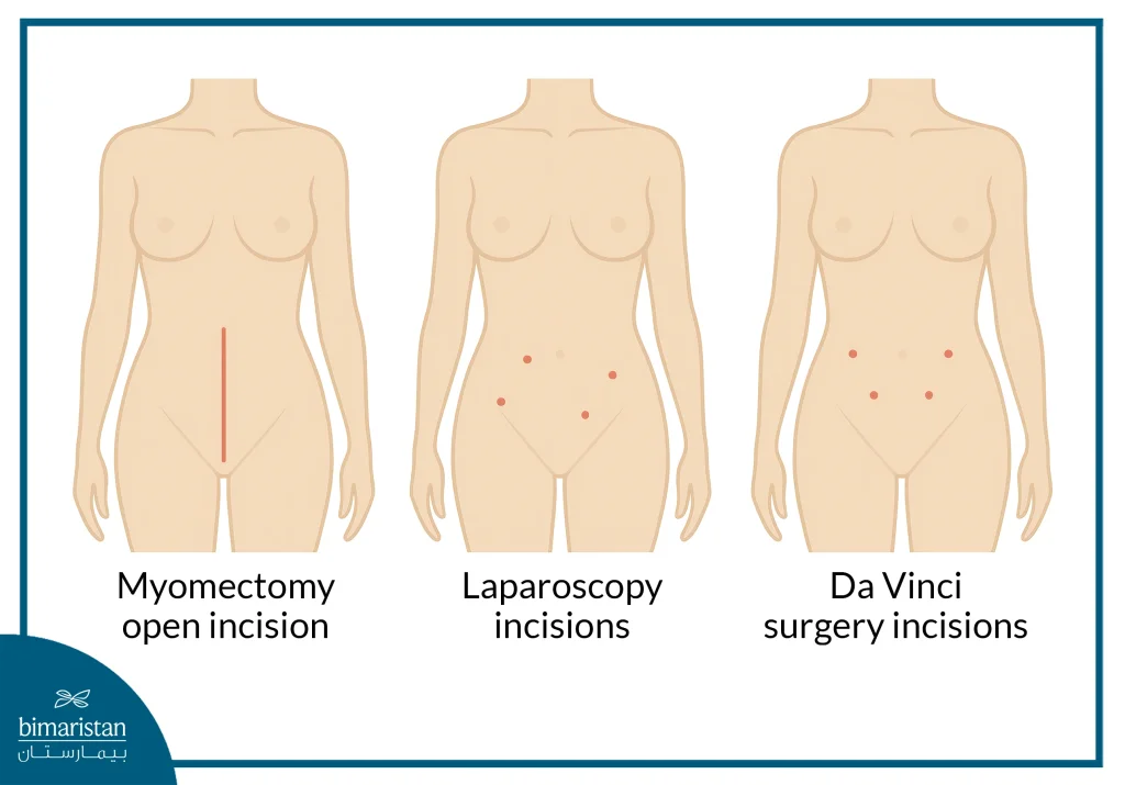 Robotic Myomectomy In Turkey: Benefits, Procedure &Amp; Cost Guide 3 Comparison Of Types Of Uteromuscular Surgery