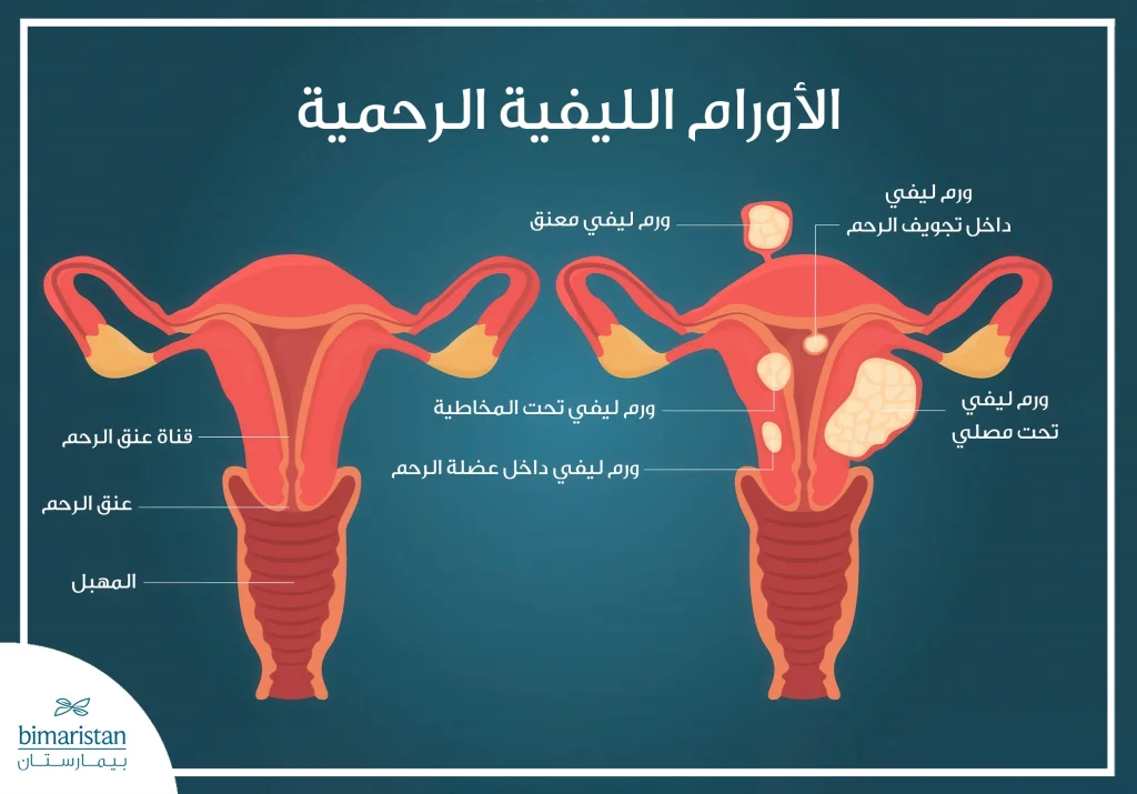 استئصال الورم الرحمي العضلي بالروبوت في تركيا 2 أنواع الأورام الرحمية الملساء
