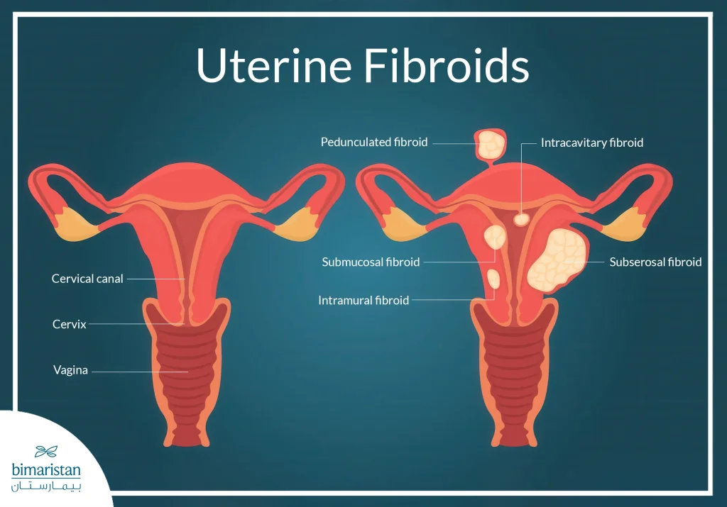 Robotic Myomectomy In Turkey: Benefits, Procedure &Amp; Cost Guide 2 Uterine Fibroids Types