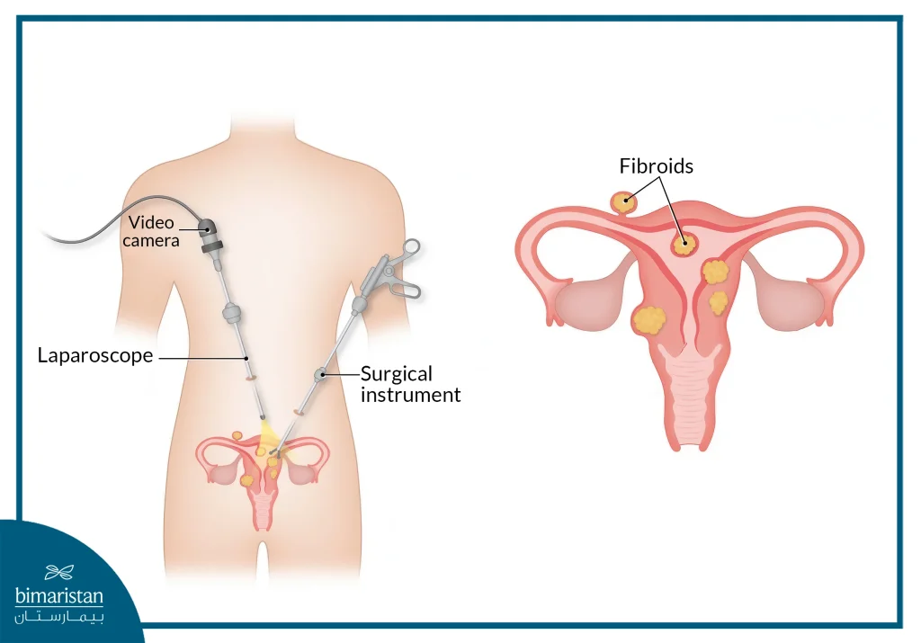 Robotic Myomectomy In Turkey: Benefits, Procedure &Amp; Cost Guide 4 Image Of The Devices Used In Robotic Myomectomy For Uterine Myomas