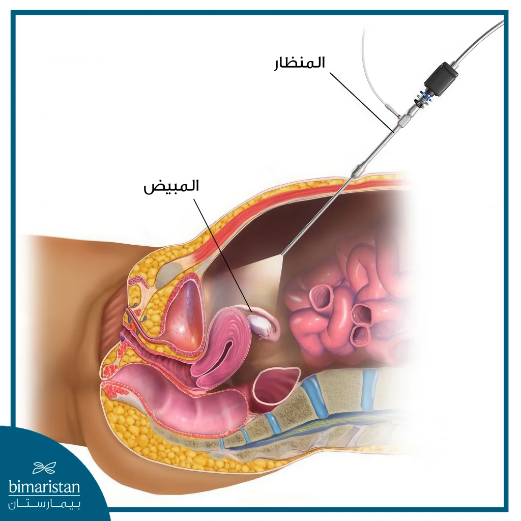 عملية استئصال كيس المبيض بالمنظار 4 استئصال كيس المبيض بالمنظار