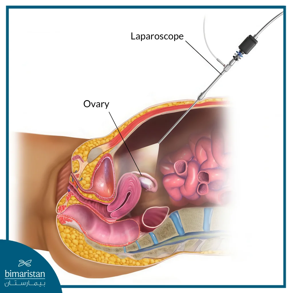 Laparoscopic Ovarian Cyst Removal In Turkey: Advanced Minimally Invasive Treatment For Optimal Healing 4 Laparoscopic Ovarian Cyst Removal