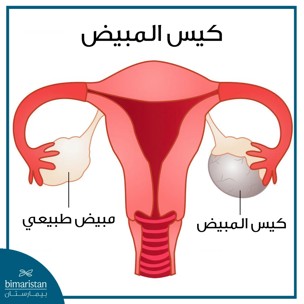 عملية استئصال كيس المبيض بالمنظار 2 شكل كيس المبيض
