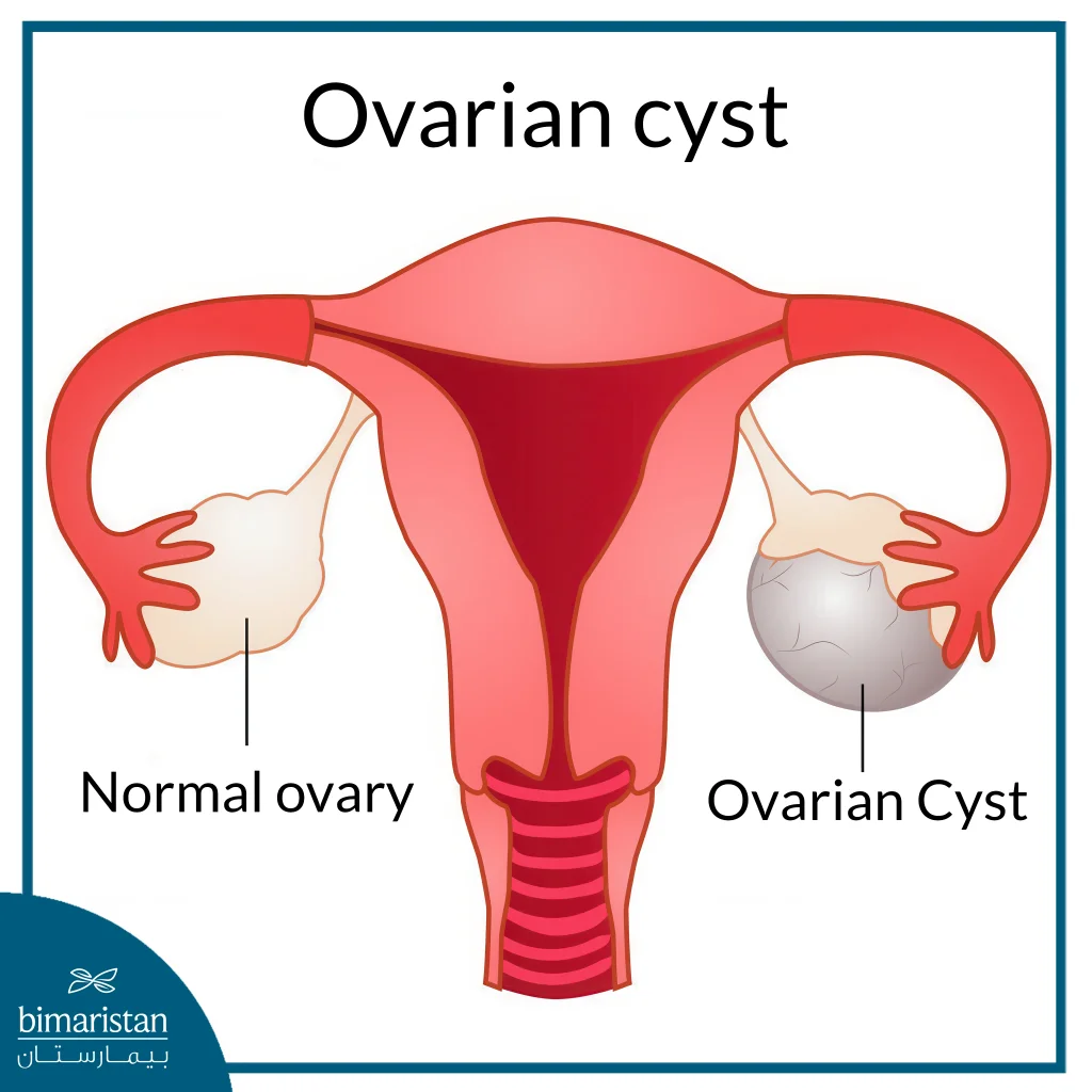 Laparoscopic Ovarian Cyst Removal In Turkey: Advanced Minimally Invasive Treatment For Optimal Healing 2 Ovarian Cyst