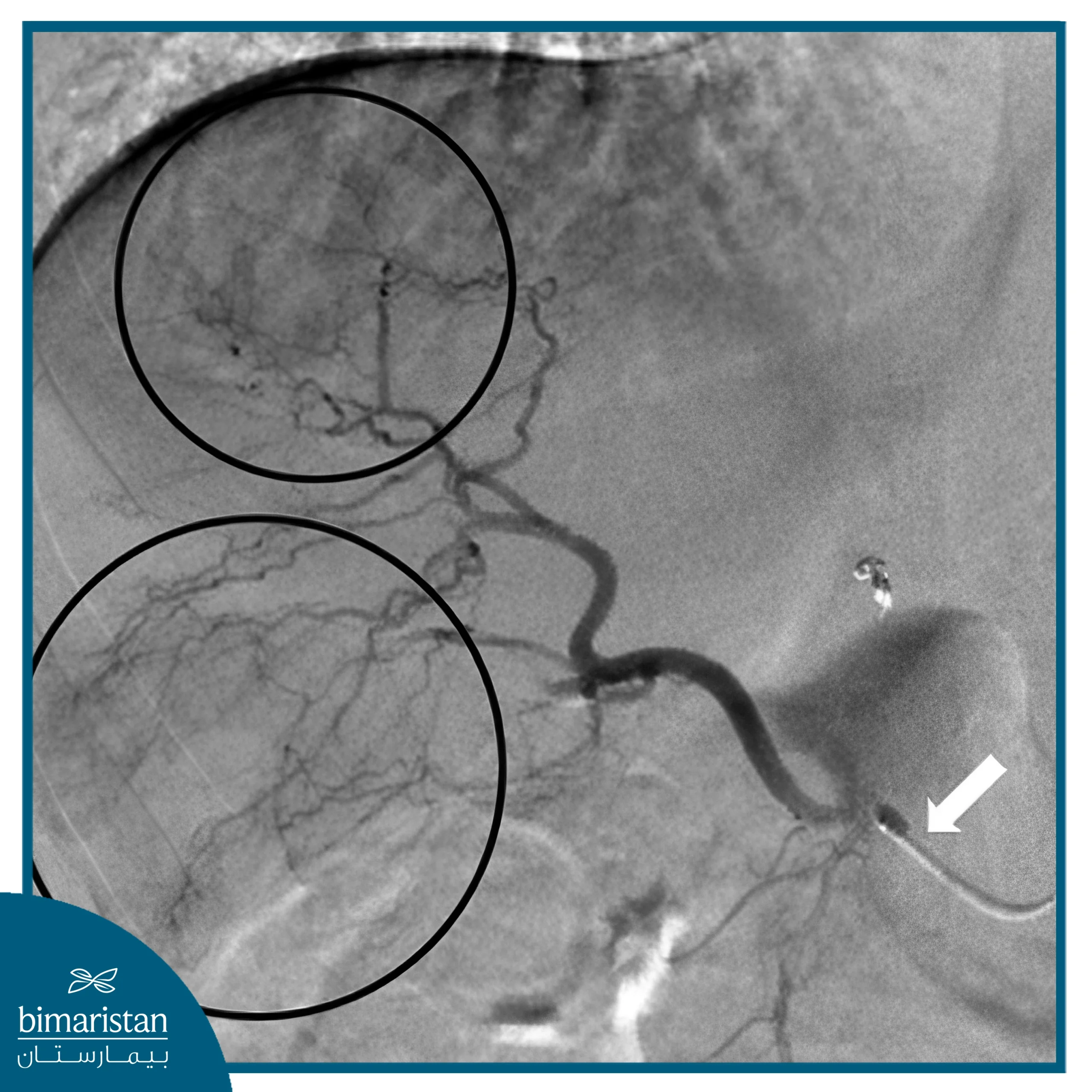 Radioembolization: Everything You Need To Know 2 Contrast Imaging Showing Increased Awareness At The Site Of The Liver Tumor