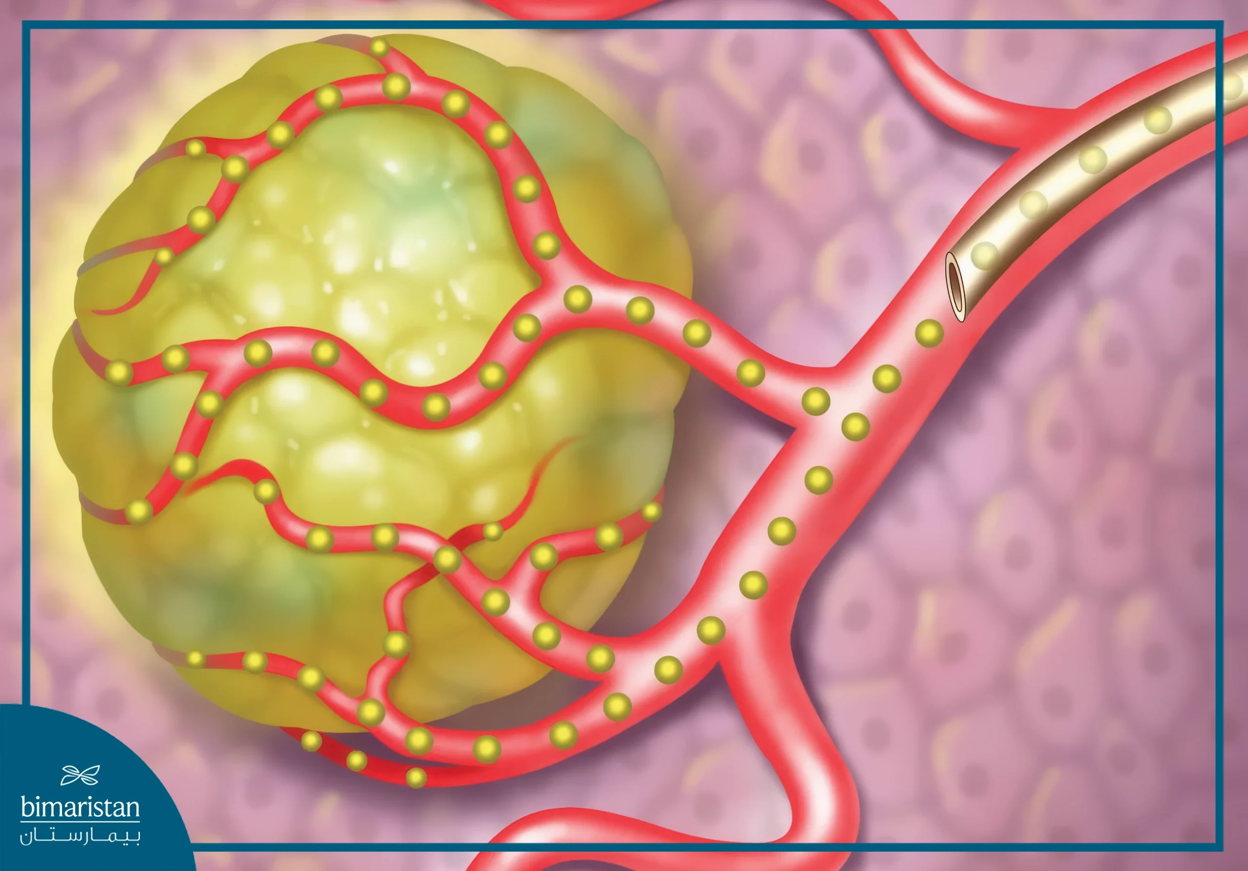Radioembolization: Everything You Need To Know 3 Radioembolization Involves Inserting A Catheter Into An Artery To Inject Radioactive Particles Into The Tumor Site.