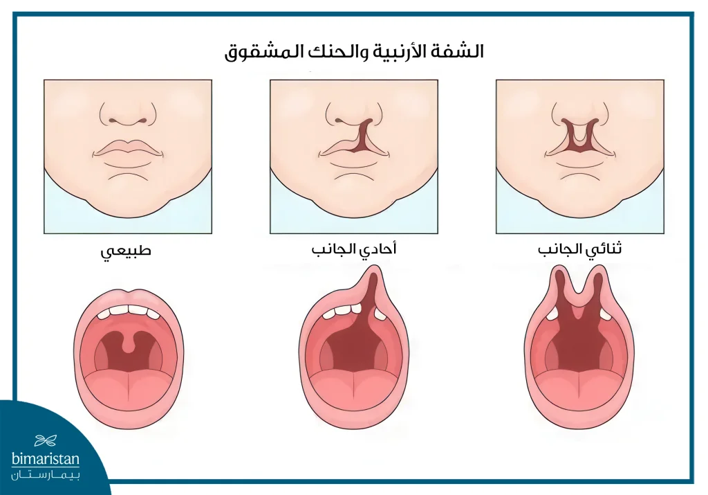 الشفة الأرنبية والحنك المشقوق: الأسباب وسبل العلاج 2 قد تكون الشفة الأرنبية أحادية الجانب أو ثنائية الجانب