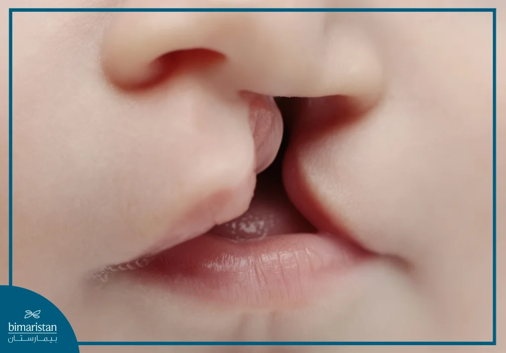 الشفة الأرنبية والحنك المشقوق: الأسباب وسبل العلاج 3 طفل لديه حالة الشفة الأرنبية
