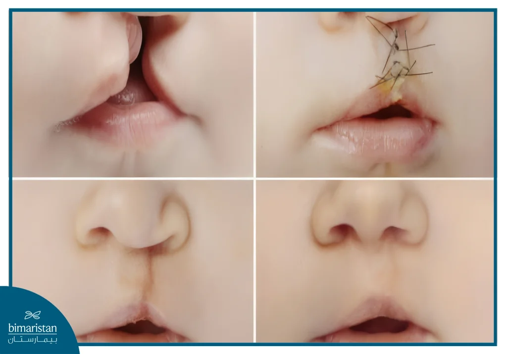 Cleft Lip And Cleft Palate: Causes, Treatments, And Recovery 4 The Appearance Of The Cleft Lip After Cleft Lip Surgery In Turkey