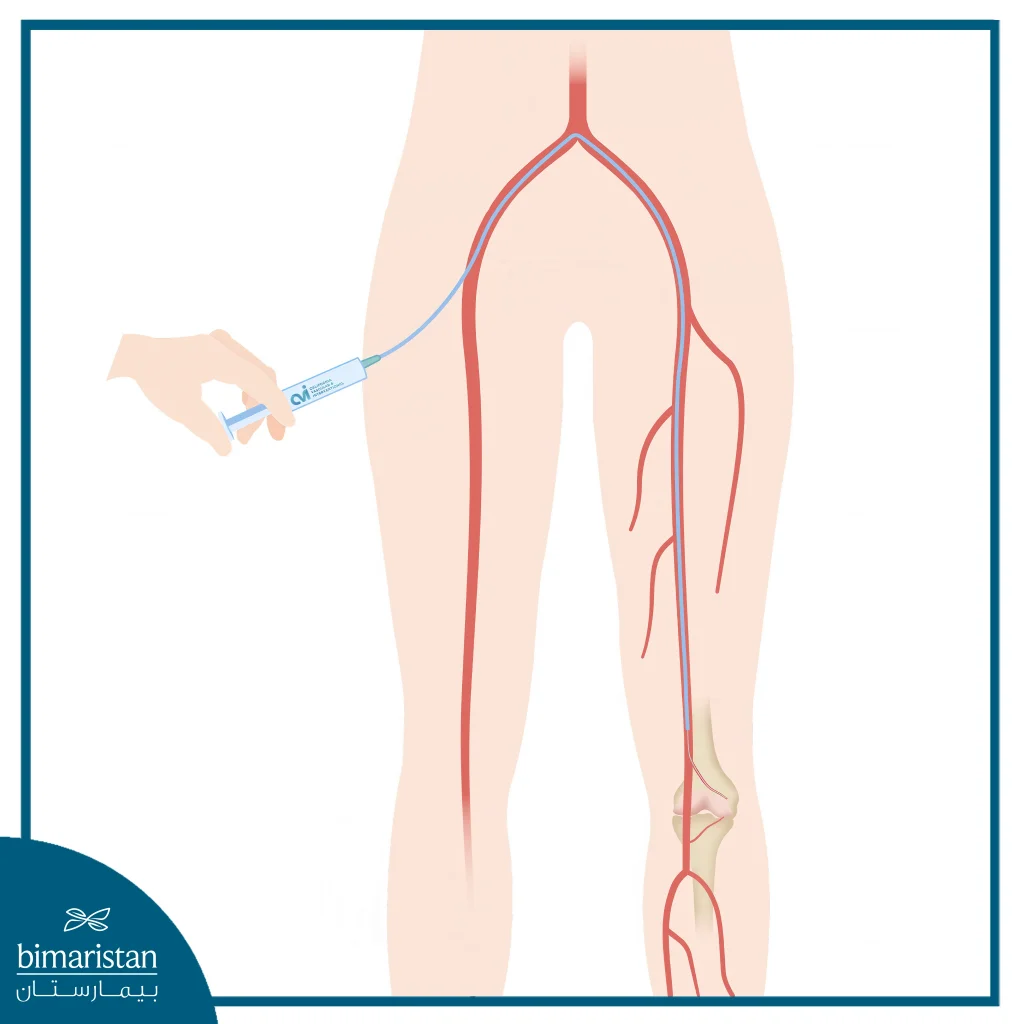 Genicular Arterial Embolization 2 Image Showing Genicular Arterial Embolization