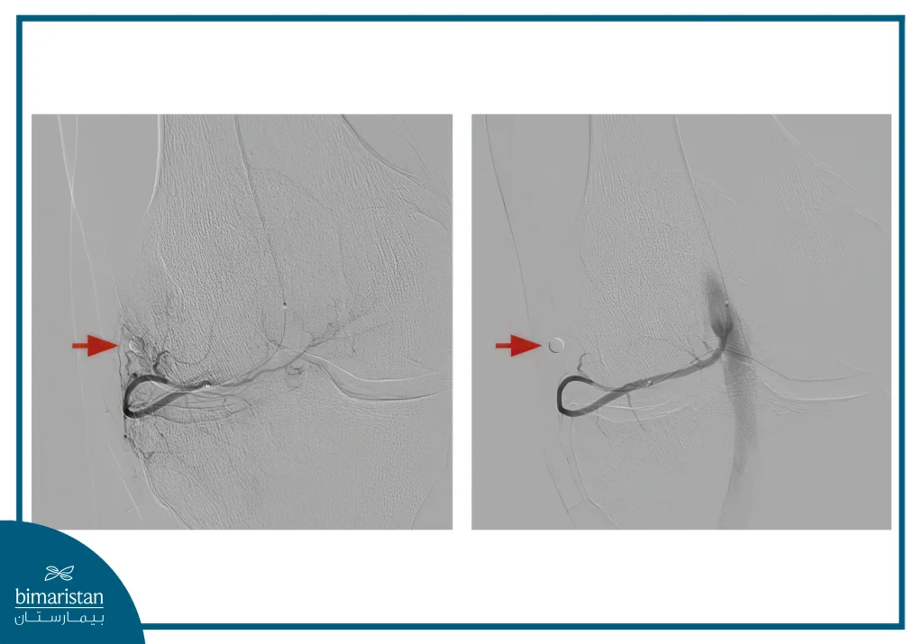 Genicular Arterial Embolization 3 Shadow Image Showing The Arteries Of The Knee Before And After Embolization