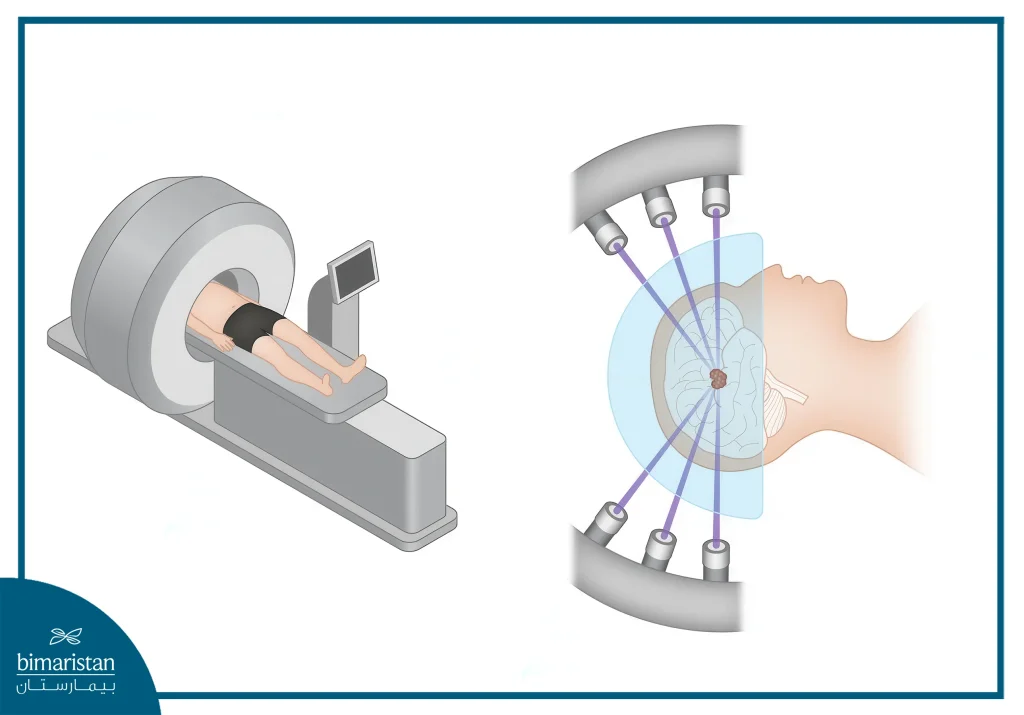 Gamma Knife Surgery 3 Stereotactic Radiosurgery Using Gamma Knife