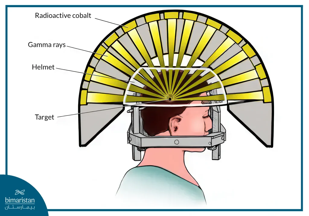 Gamma Knife Surgery 4 Gamma Knife Surgery Is A Form Of Stereotactic Radiosurgery Using The Gamma Knife Device.