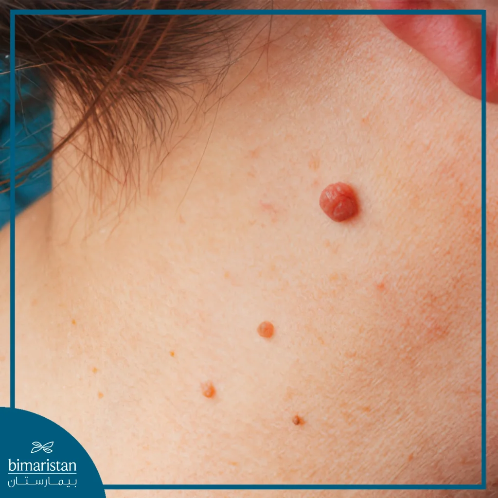 Skin Cancers: Causes, Symptoms &Amp; Effective Treatment Guide 4 Benign Skin Cancer With Pictures