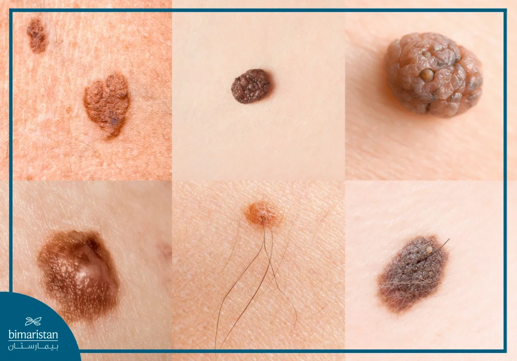 Skin Cancers: Causes, Symptoms &Amp; Effective Treatment Guide 2 A Group Of Possible Skin Changes, Which May Be Signs Of Different Types Of Skin Cancer.