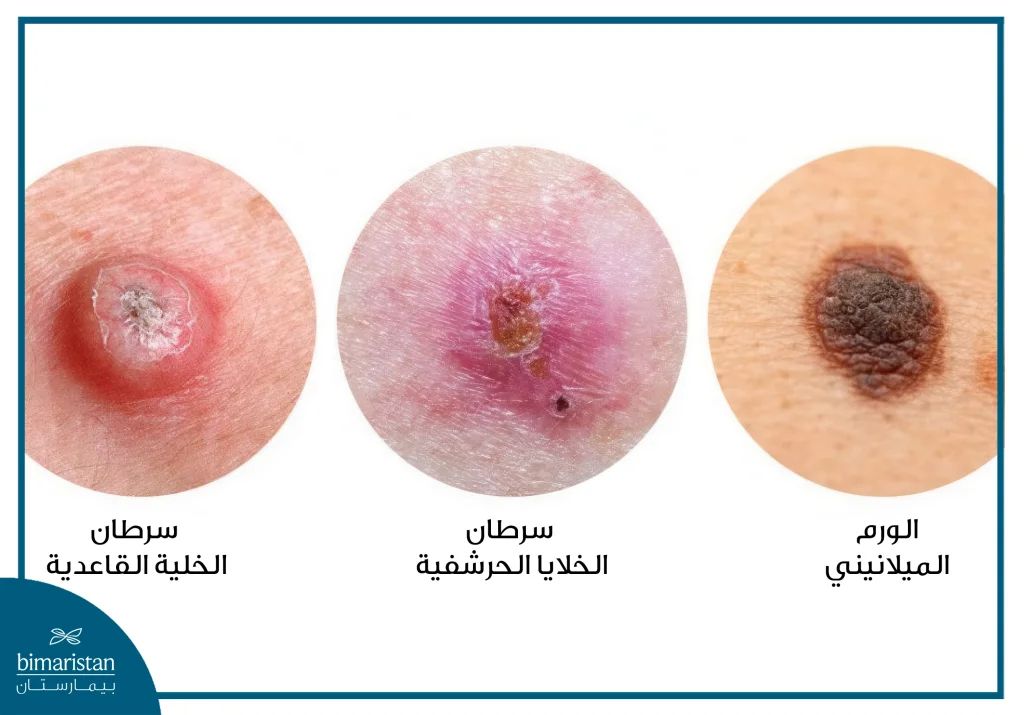 سرطان الجلد: كل ما يجب أن تعرفه عن أخطر أنواع السرطان الشائعة 3 أنواع سرطان الجلد بالصور