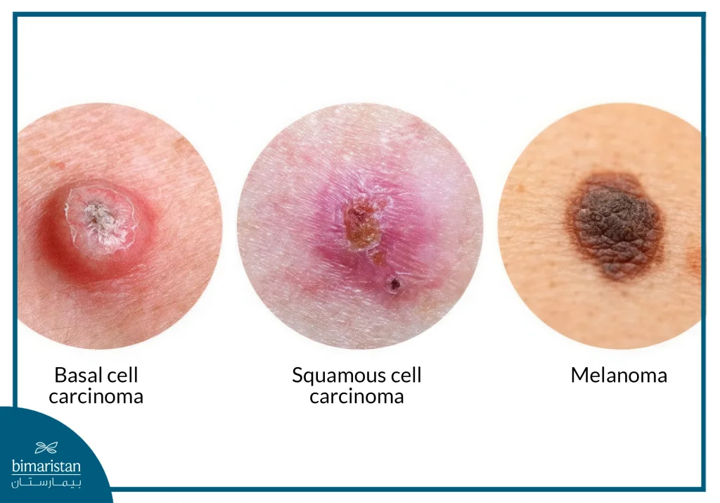 Skin Cancers: Causes, Symptoms &Amp; Effective Treatment Guide 3 Types Of Skin Cancers