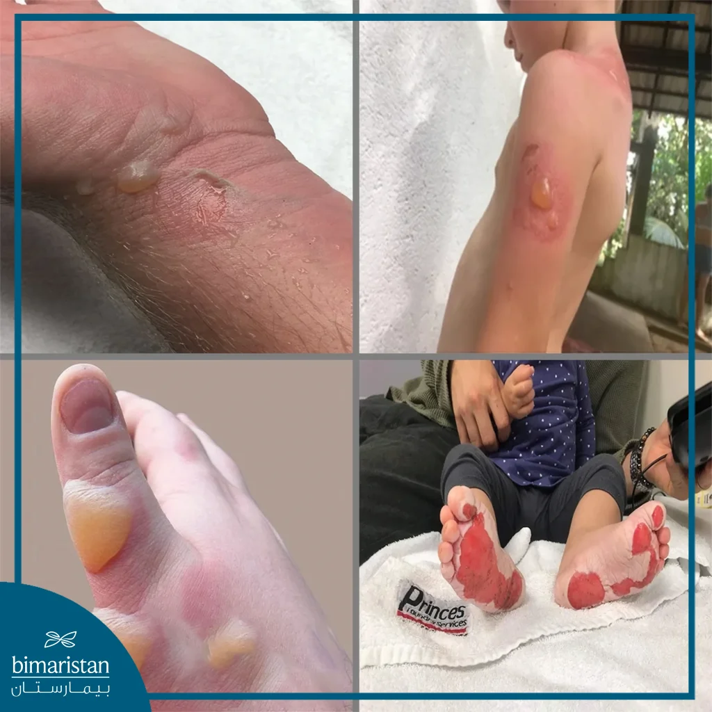 Burns Treatment: Types, Home Remedies &Amp; Prevention 3 Pictures Of Second-Degree Burns Treatment, Which Usually Appear As Blisters Or Peeling.