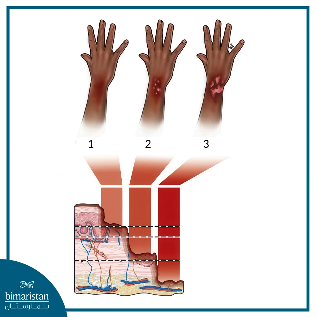 Burns Treatment: Types, Home Remedies &Amp; Prevention 2 Pictures Of Some Cases That Require Burns Treatment, Including First, Second, And Third Degree Burns.