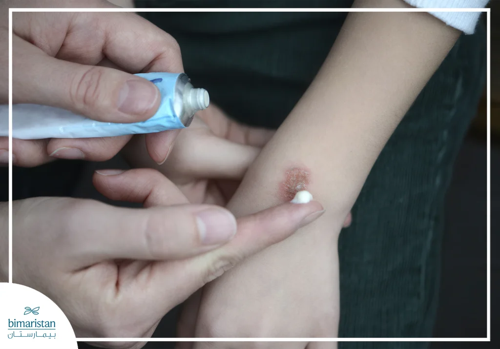Burns Treatment: Types, Home Remedies &Amp; Prevention 4 علاج الحروق 3 Eng