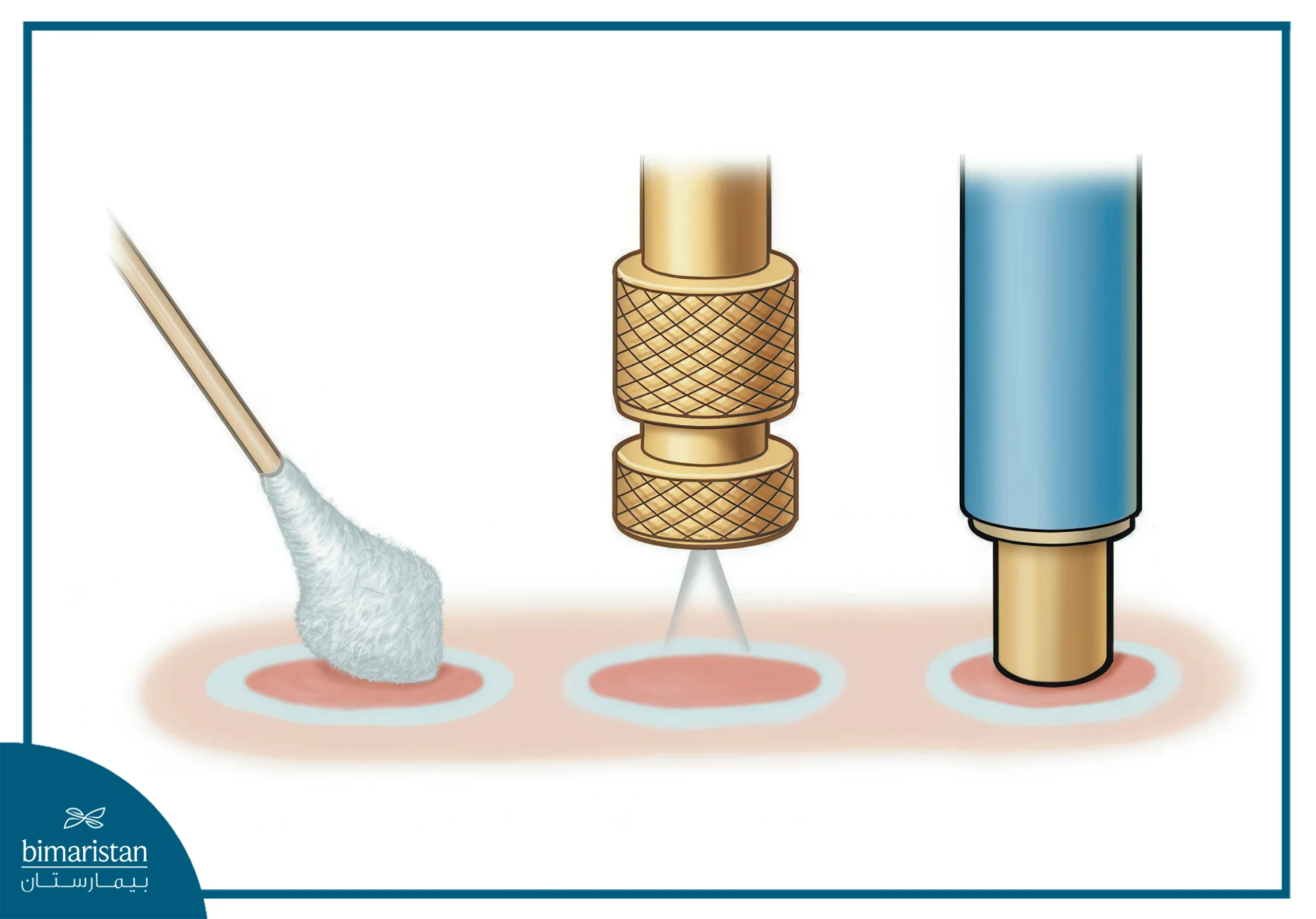 Cryotherapy For Cancer In Turkey: Alternative To Surgery? 3 There Are Different Types And Shapes Of Probes, But They All Perform Roughly The Same Function.