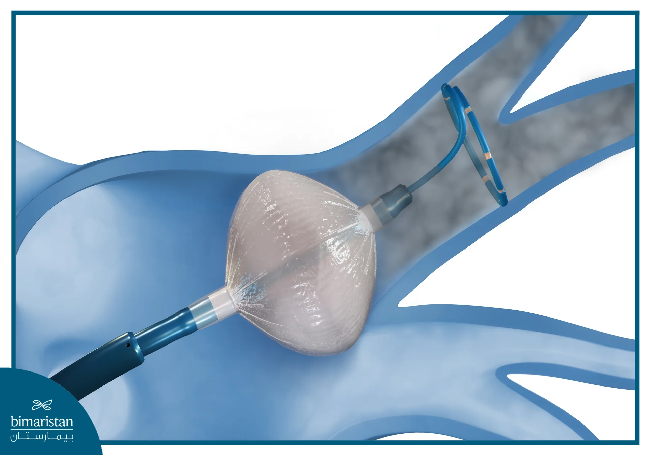 Cryotherapy For Cancer In Turkey: Alternative To Surgery? 2 The Image Shows A Cryotherapy Method For Treating Cancer By Inserting A Cryogenic Probe To Precisely Freeze And Destroy Cancer Cells.