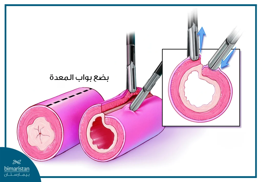 علاج تضيق البواب: تعريف عن المرض وأهم طرق علاجه 5 علاج تضيق البواب عبر جراحة بضع بواب المعدة