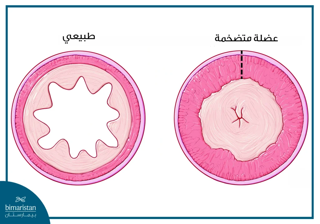 علاج تضيق البواب: تعريف عن المرض وأهم طرق علاجه 4 مقارنة بين لمعة بواب المعدة الطبيعي وبواب المعدة المتضيق