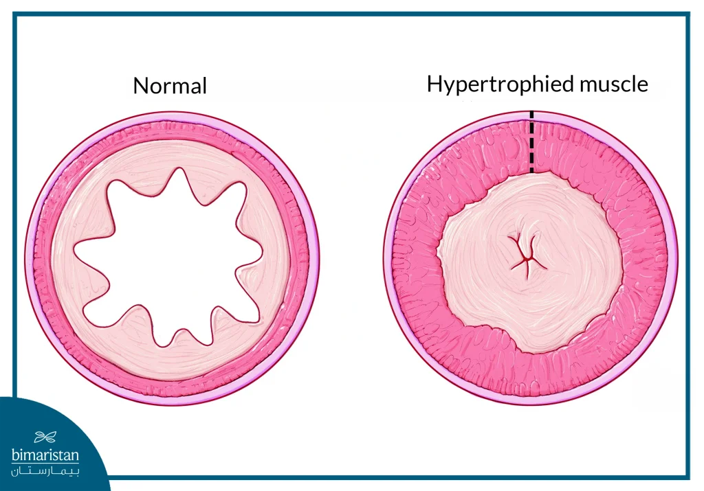 Pyloric Stenosis Treatment: Effective Methods And Solution 4 Comparison Between The Lumen Of Normal Pylorus And Pyloric Stenosis