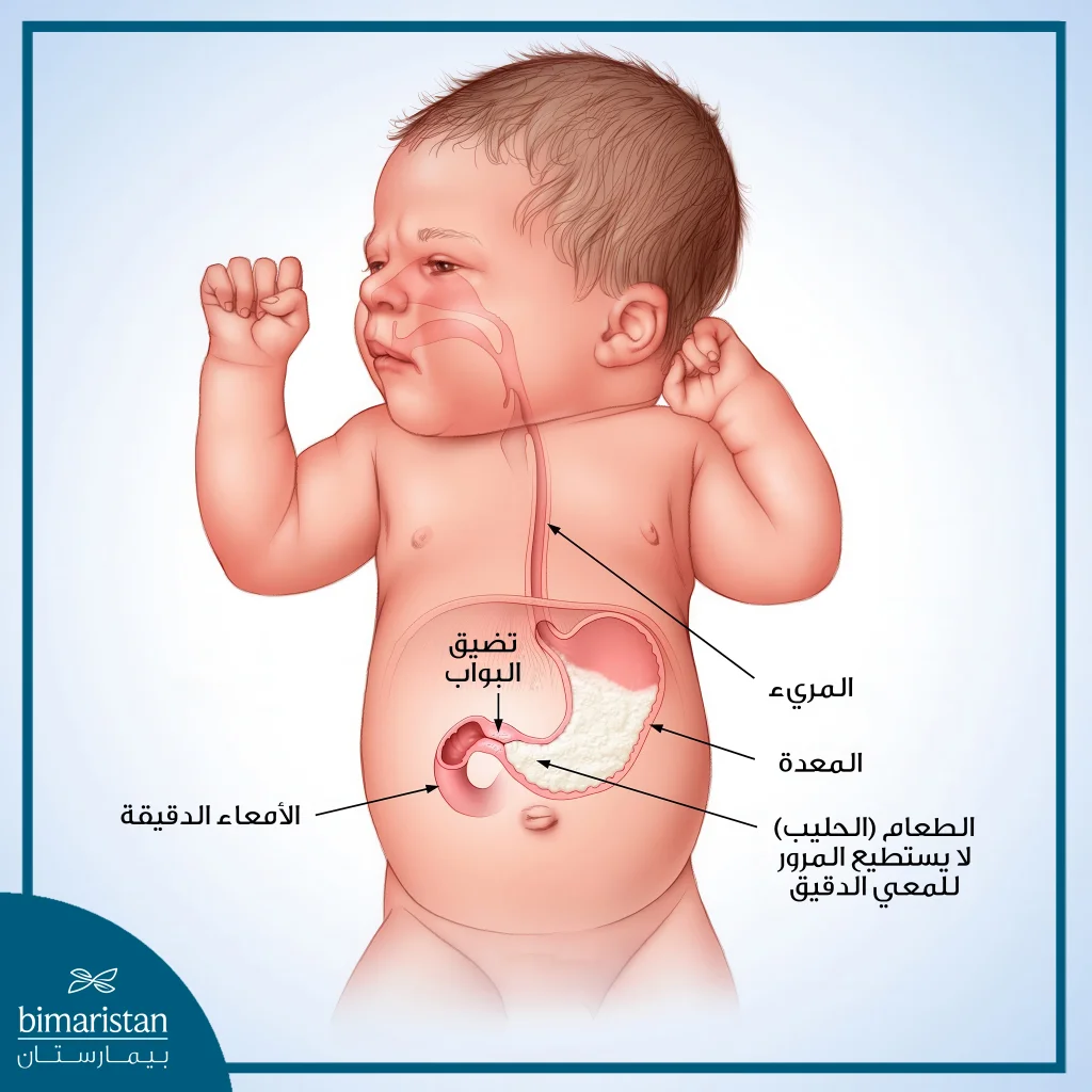 علاج تضيق البواب: تعريف عن المرض وأهم طرق علاجه 3 توضيح لحالة تضيق بواب عند طفل ونلاحظ احتباس الطعام وصعوبة مروره عبر البواب المتضيق