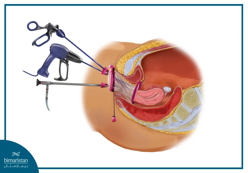 Oophorectomy: Indications And Alternatives 3 Vaginal Natural Orifice Transluminal Endoscopic Surgery (Vnotes) Technique