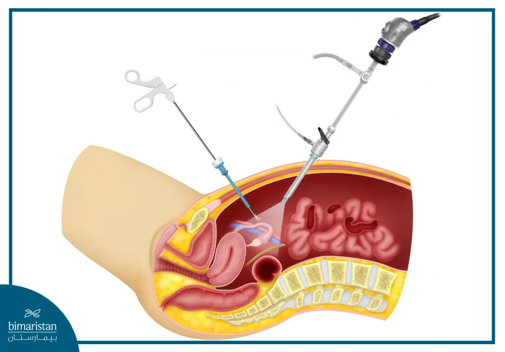 Oophorectomy: Indications And Alternatives 2 Illustration Showing Laparoscopic Oophorectomy Through Two Abdominal Incisions Using A Camera And Microsurgical Instruments.