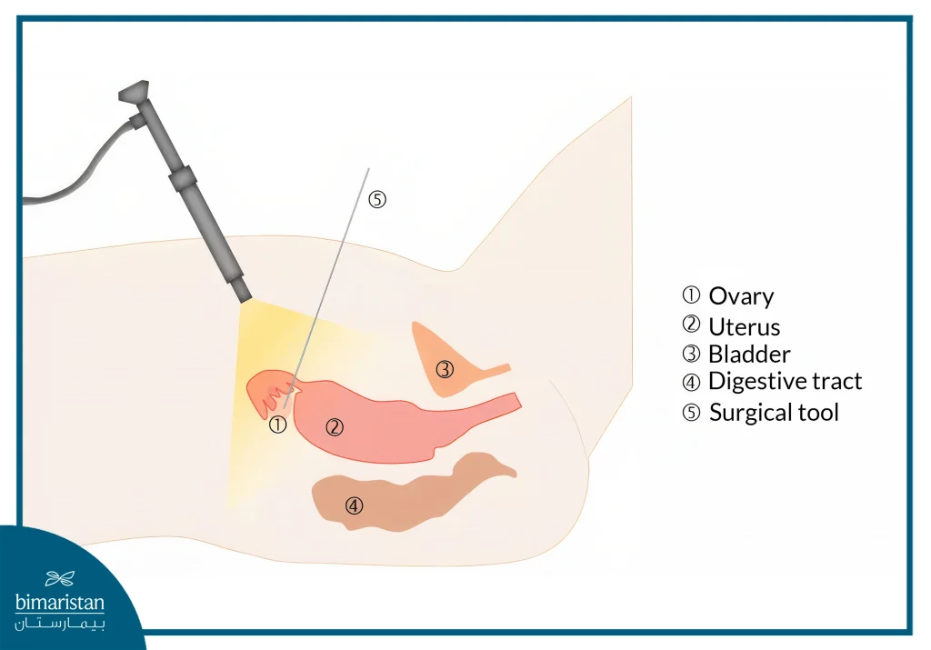 Oophorectomy: Indications And Alternatives 4 Laparoscopic Ovarian Drilling