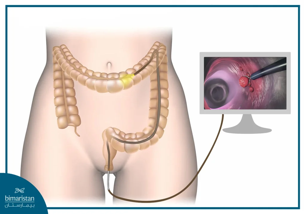 Laparoscopic Removal Of Mucosal Colon Polyps In Turkey: Advanced, Minimally Invasive Treatment 4 Colonoscopy To Detect The Location Of Colon Polyps