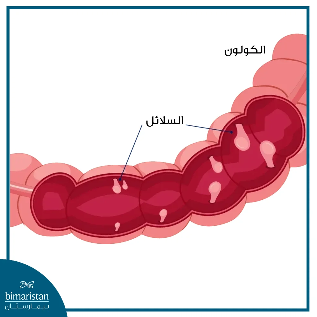 عملية استئصال سلائل القولون المخاطية بالمنظار 3 شكل سلائل القولون المخاطية