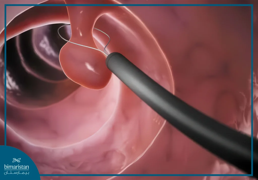 عملية استئصال سلائل القولون المخاطية بالمنظار 5 استئصال سلائل القولون المخاطية بالمنظار باستخدام الحلقة الكهربائية