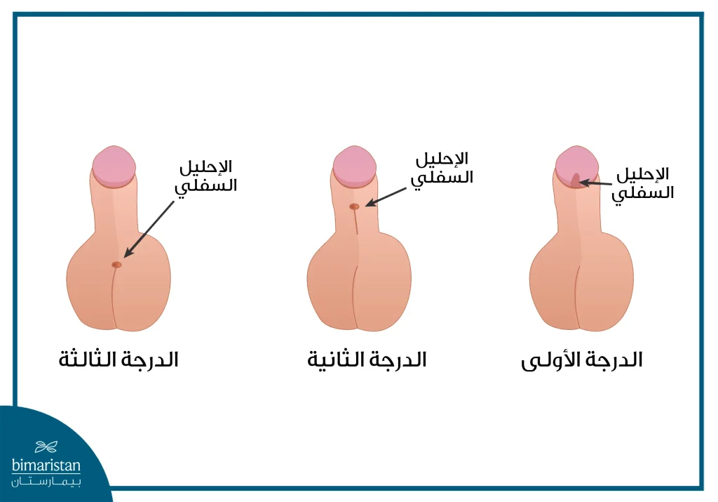 عملية الإحليل السفلي: تعرف على أسباب عملية الإحليل السفلي وأعراضه وطرق علاجه 2 درجات الإحليل السفلي