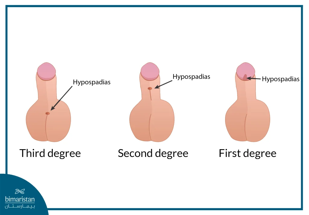 Types Of Hypospadias