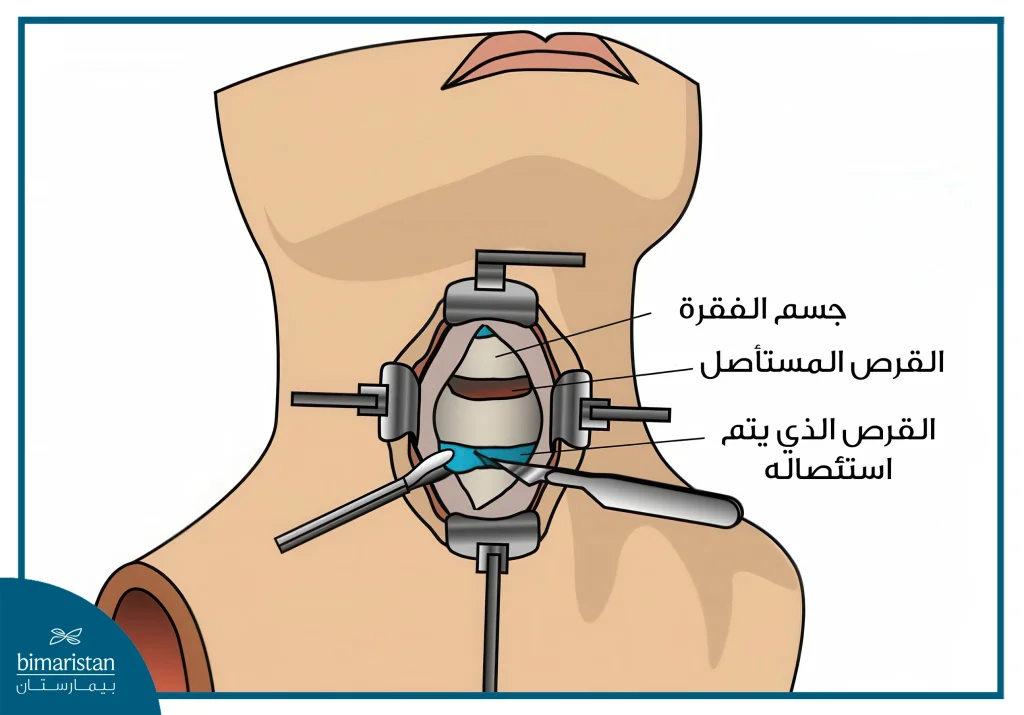 عملية تثبيت الفقرات الرقبية 2 عملية الاستئصال الأمامي للغضروف الرقبي والدمج (Acdf)