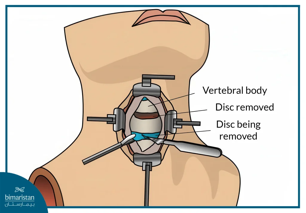 Cervical Spine Fusion Surgery In Turkey: Techniques, Recovery Tips &Amp; Success Rates 3 Anterior Cervical Discectomy And Fusion (Acdf)