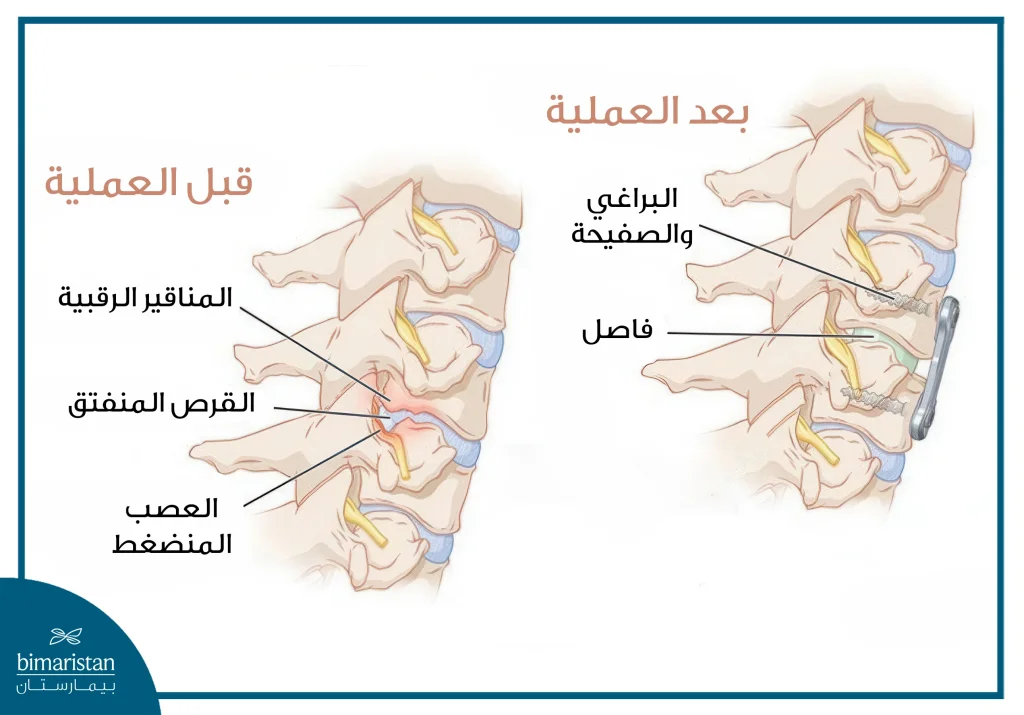 عملية تثبيت الفقرات الرقبية 4 عملية تثبيت الفقرات الرقبية قبل وبعد