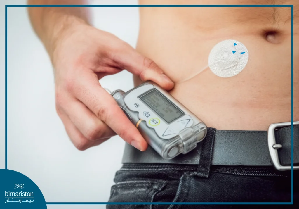 Insulin Pump To Treat Diabetes Disease