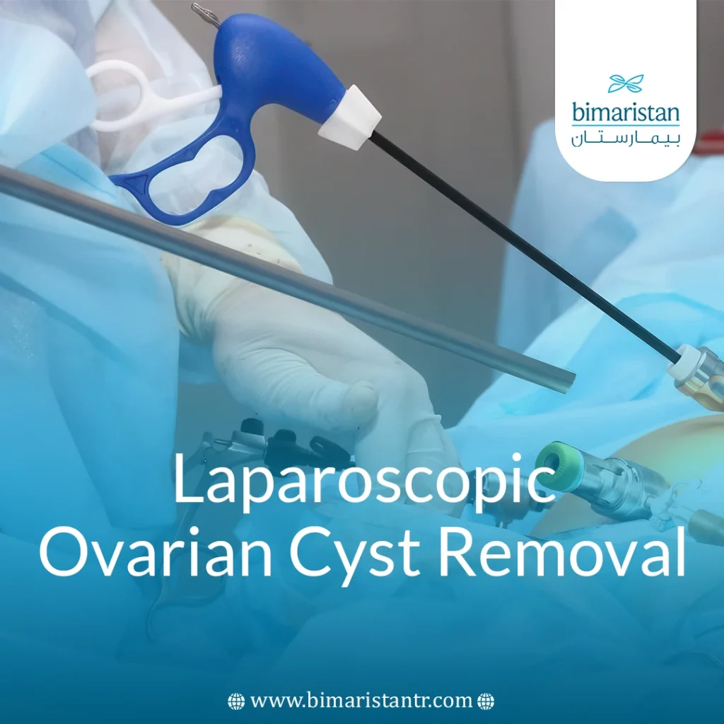 Laparoscopic Ovarian Cyst Removal