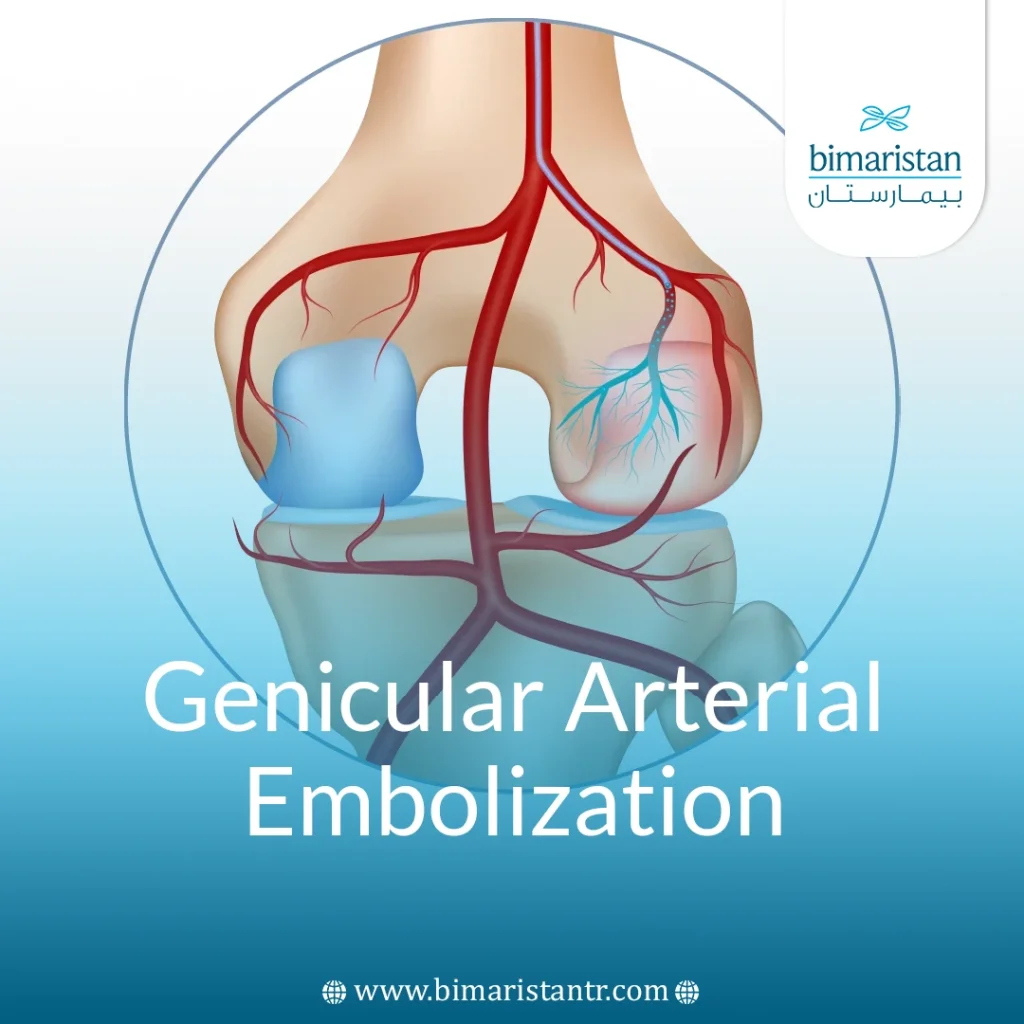 Genicular Arterial Embolization In Turkey