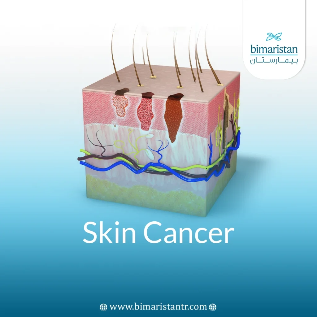 Skin Cancers: Causes, Symptoms &Amp; Effective Treatment Guide
