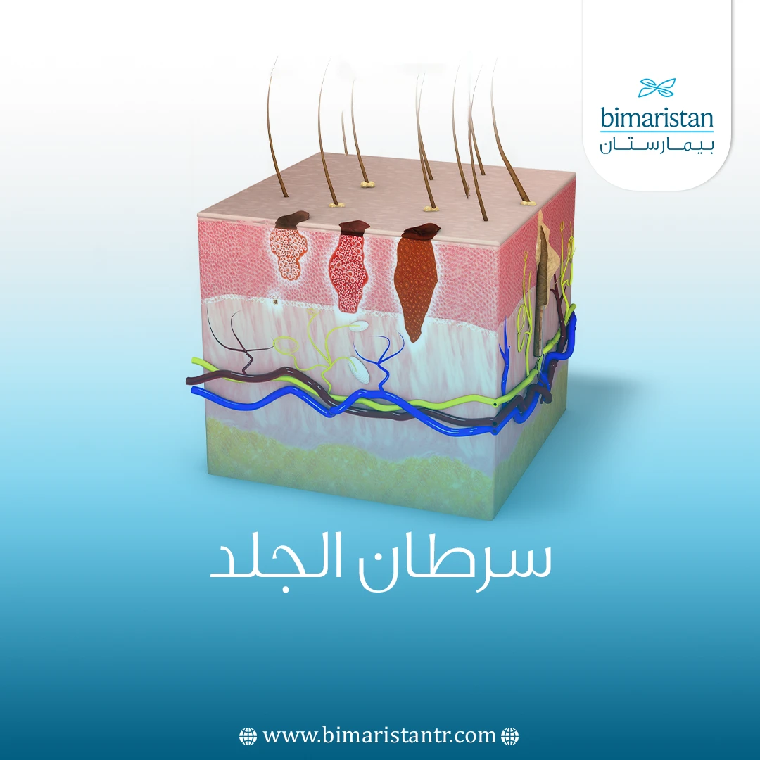 سرطان الجلد