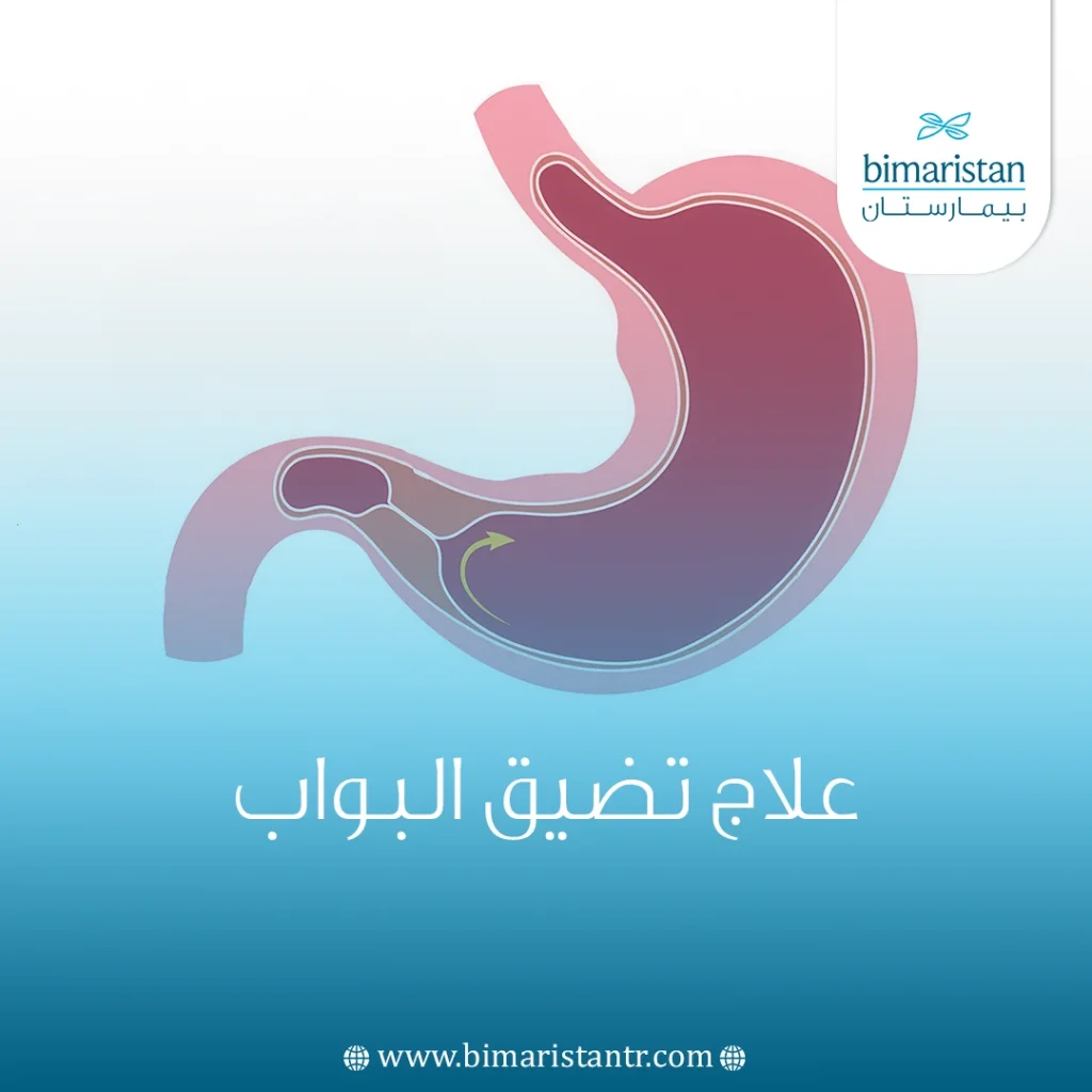 علاج تضيق البواب