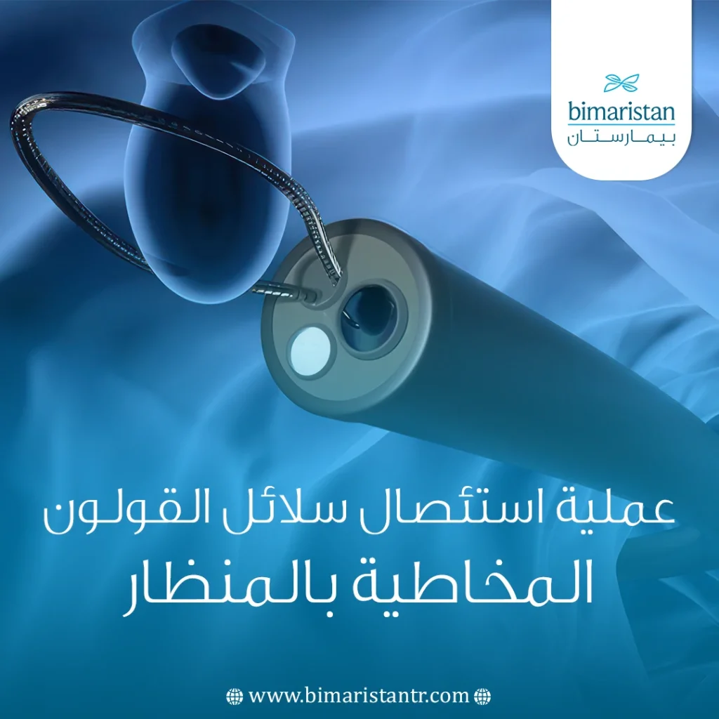 عملية استئصال سلائل القولون المخاطية بالمنظار